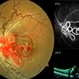 Retinal Arterio-Venous Malformations