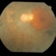 Gyrate Atrophy of Choroid and Retina