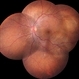 Choroidal Metastases Choroidal Metastases