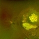 Retinoma Retinoma