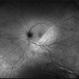Mac-on Retinal Detachment (Barely!) Mac-on Retinal Detachment (Barely!)
