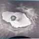 Chorio Retinal Scar