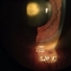 Posterior Polar Cataract Posterior Polar Cataract