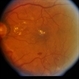 BDR / Macular Edema / Macroaneurysm BDR / Macular Edema / Macroaneurysm
