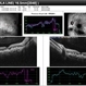 OCT Line Scan in Benign Familial Fleck Retina OCT Line Scan in Benign Familial Fleck Retina