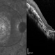 Macular Coloboma and Pigmentary Retinopathy Macular Coloboma and Pigmentary Retinopathy