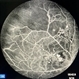 Leber's miliary aneurysms Leber's miliary aneurysms