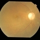 Dengue Retinitis Healed With Optic Atrophy