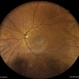 Subretinal Neovascular Membrane with PED