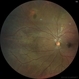 Black Sunburst in Proliferative Sickle Cell Retinopathy Black Sunburst in Proliferative Sickle Cell Retinopathy