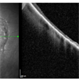 OCT Over Congenital Hypertrophy of the Retinal Pigment Epithelium (CHRPE) OCT Over Congenital Hypertrophy of the Retinal Pigment Epithelium (CHRPE)