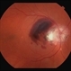Subretinal Heme Involving Fovea Before PPV Subretinal Heme Involving Fovea Before PPV