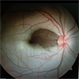 Central Retinal Artery Occlusion With Cilioretinal Sparing Central Retinal Artery Occlusion With Cilioretinal Sparing