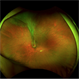 Ocular Toxocariasis with  Peripheral Granuloma
