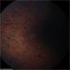 Usher's Syndrome Usher's Syndrome