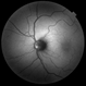 Autofluorescence in Optic Nerve Head Drusen Autofluorescence in Optic Nerve Head Drusen