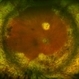 Scleral Buckle with 360 Degree Laser Scleral Buckle with 360 Degree Laser