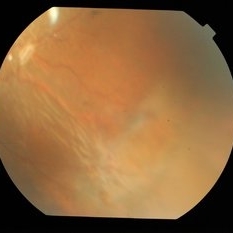 Retinal Folds Following Retinal Reattachment Surgery - Retina Image Bank