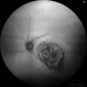 Choroidal Hemangioma, Autofluorescence Choroidal Hemangioma, Autofluorescence