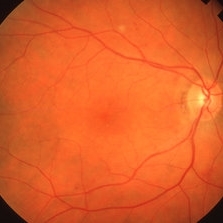 MULTIPLE MYELOMA - Retina Image Bank