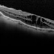 Retained  Perfluorcarbon and Macular Edema After Silicon Oil Removal Retained  Perfluorcarbon and Macular Edema After Silicon Oil Removal
