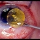 Cataract Cataract