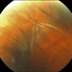 Retinal Incarceration Following External Drainage of Subretinal Fluid