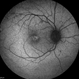 X-Linked Retinoschisis X-Linked Retinoschisis