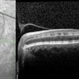 Paracentral Acute Middle Maculopathy (PAMM) Paracentral Acute Middle Maculopathy (PAMM)