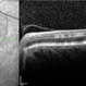 Paracentral Acute Middle Maculopathy Paracentral Acute Middle Maculopathy
