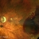 Peripheral haemorrhagic. Choroidopathy Peripheral haemorrhagic. Choroidopathy
