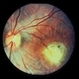 Toxocara Granuloma Toxocara Granuloma