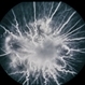 Combined Retinal / RPE Hamartoma Combined Retinal / RPE Hamartoma
