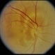 Scleritis / OIS Scleritis / OIS
