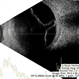 Retinal Detachment