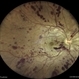 Combined Central Retinal Artery and Vein Occlusion Combined Central Retinal Artery and Vein Occlusion