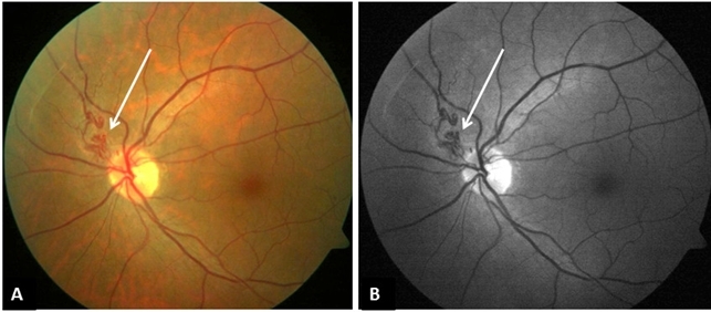 Compressive Vascular Loop Vascular-Loop-Syndrom _ Kleinhirnbrückenwinkel Symptome – YGQDYT