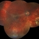 Epiretinal Membrane Epiretinal Membrane