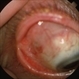 Exposed Scleral Buckle Exposed Scleral Buckle