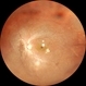 Subclinical RD in Retinitis Pigmentosa