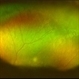 Retinopathy of Prematurity