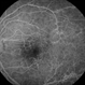 Idiophatic retinal vasculitis