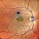 Adult Vitelliform Macular Dystrophy Adult Vitelliform Macular Dystrophy
