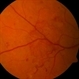PDR Neovacularization PDR Neovacularization