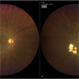 Myelinated Nerve Fibres in left eye with old tributary vein occlusion in left eye Myelinated Nerve Fibres in left eye with old tributary vein occlusion in left eye