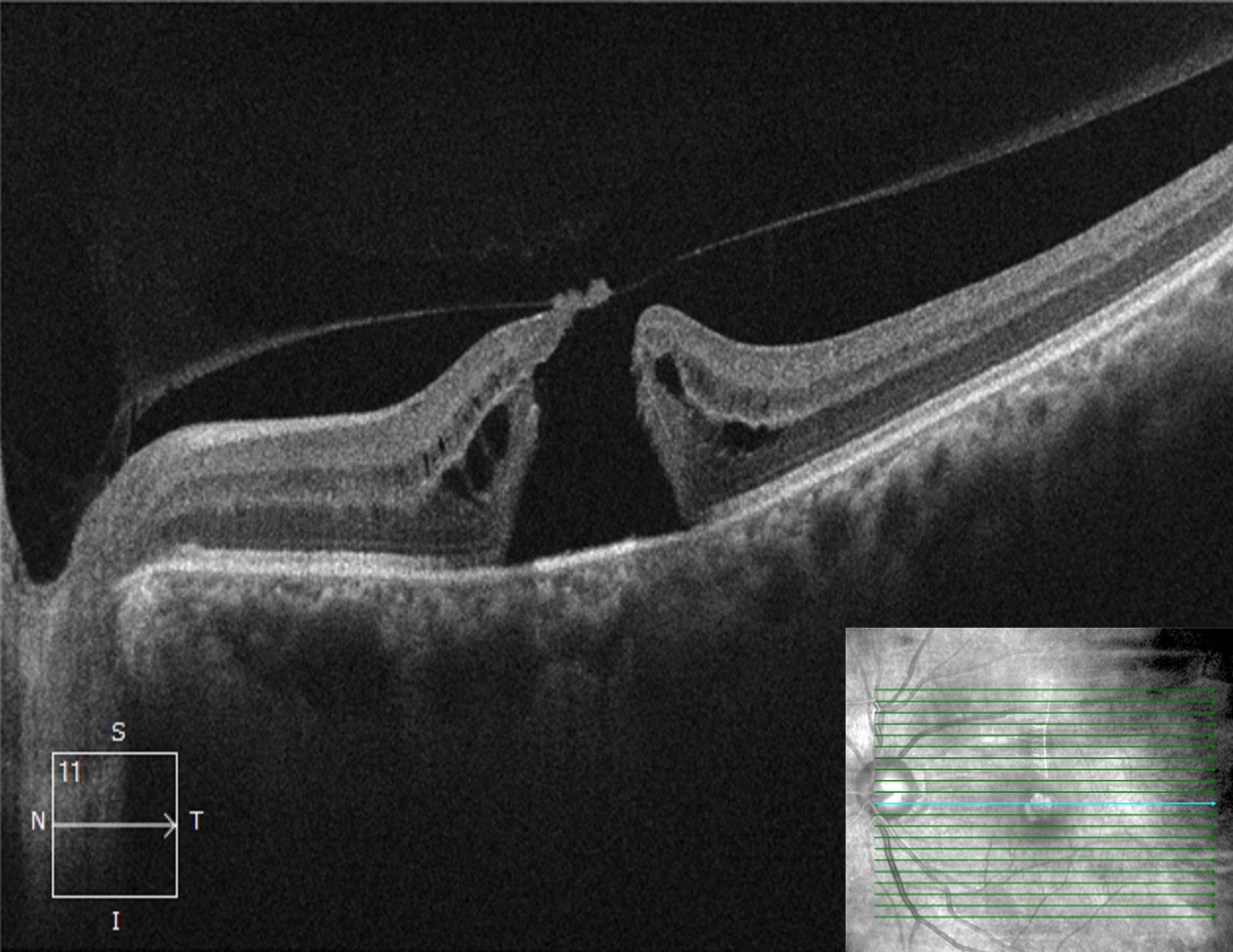 vmt retina vmt retina