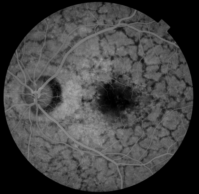 Reticular Pattern Dystrophy - Retina Image Bank