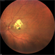 End Point of Macular Telangiectasia (Mac Tel) Type 2 End Point of Macular Telangiectasia (Mac Tel) Type 2