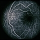 Congenital Disc Anomaly Congenital Disc Anomaly