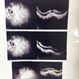 Myopic Foveoschisis